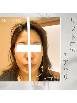 美バリ 新宿店(美BARI)/エアバリ 1回