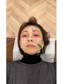 エムアンドエス鍼灸整骨院(M&S鍼灸整骨院)/立体造顔美容鍼