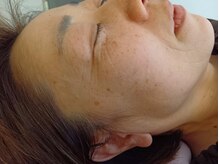 麻謝/Sou顔+ゼオライトマスク施術前