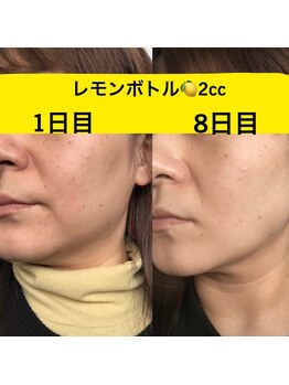 ララチッタ(L'la citta)/レモンボトル2cc