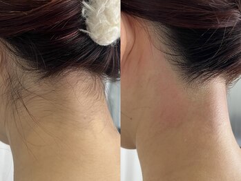 シロ(Shiro)/MIX脱毛うなじデザイン