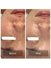 ミピブ 梅田(mipibu)/美白ケア！光フェイシャル