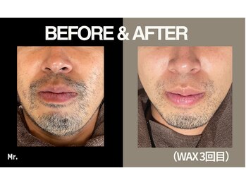 ミスター(Mr.)/【ワックス脱毛】
