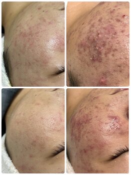 肌管理-SIASKIN-【4/1 NEW OPEN(予定)】/ニキビお悩みのお客様