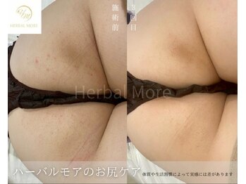 スキニティ 池袋(sknity)/<お尻>黒ずみ・肌荒れ後集中ケア