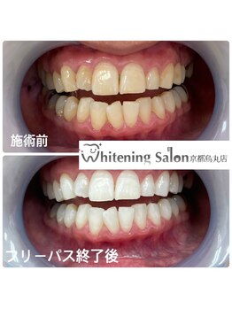 ホワイトニングサロン 京都烏丸店/ホワイトニング施術例