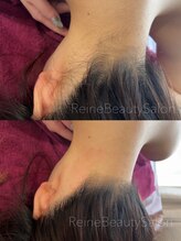 レーヌ(Reine)/うなじ・えりあし脱毛