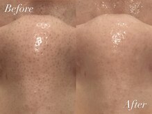 ケアナ 麻布十番店(CareNa)/毛穴を制して美肌を制す！