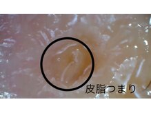 ミント/マイクロスコープにて毛穴拡大