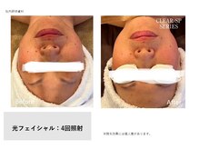 イル 名取店(iru)/光フェイシャル