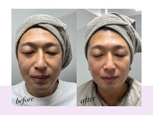 スキンラボ ドットシキブ 厚木海老名店(skinlabo .sikibu)/メンズ小顔シェイプサーモ