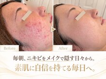 ポアレ(POARE)の雰囲気(男性は毛穴つまってニキビになる方が圧倒的に多い!正しいケアを)
