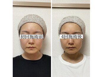 キュープ 相模原淵野辺店(Qpu)/たった4回で人生で1番小さな顔に