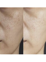 プラチナスタイル(platinum.style)/毛穴洗浄 before after