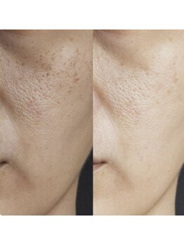 プラチナスタイル(platinum.style)/毛穴洗浄 before after