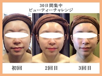 モルティー 宇都宮東店(Molti)/たるみ/引き締め/小顔矯正/BTX