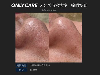 オンリィケア 近大前(ONLY CARE)/【メンズ毛穴洗浄】