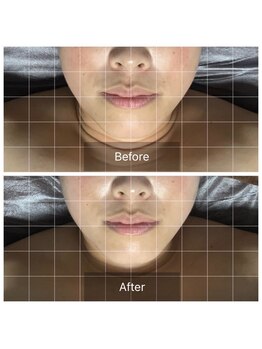 レグラージュ(Reglage)/１回の施術・Before＆After