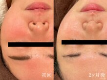 ウォーム(warm)/【美白への一歩が現実へ】小顔