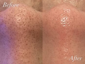 ケアナ 麻布十番店(CareNa)/毛穴を制して美肌を制す！