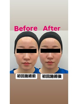 ゆうはり鍼灸整骨院 恵比寿/お客様Before　After