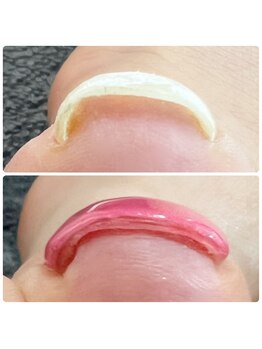 アンドネイル(+ and Nail)/巻き爪ケア/フットワンカラー
