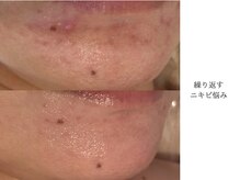 アン(An)/繰り返す肌トラブル