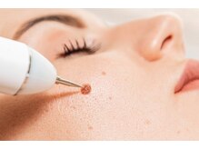 ブリリアンス(Brilliance)/【当て放題】シミケア30分