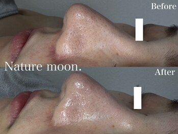 ナチュールムーン(Nature moon.)/毛穴洗浄