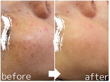 パールホワイトニングサロン 茅ヶ崎店/ハーブピーリング