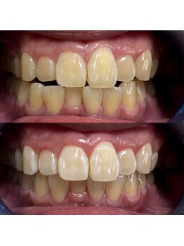 グレイスホワイトニング ヨコハマ(Grace Whitening Yokohama)/40分照射＋水素吸引