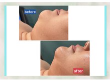 サロン ド メタセコイア(salon de Metasequoia)/筋膜リフト／before☆after