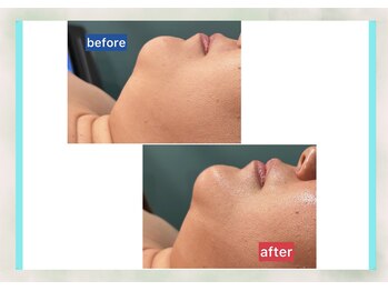 サロン ド メタセコイア(salon de Metasequoia)/筋膜リフト／before☆after