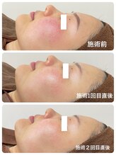 フェイシャルエステ エムズルーム(M's room)/高濃度プラセンタ導入★赤み改善