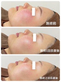 フェイシャルエステ エムズルーム(M's room)/高濃度プラセンタ導入★赤み改善