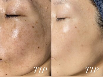 ソリッジ肌管理室/シミケア・毛穴　TIPサイエンス