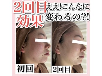 ホワイトアクア 天王寺本店(WHITE AQUA)/ハーブピーリング/大阪/天王寺