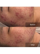 ラヴニール(L'avenir)/ニキビとはおさらば！