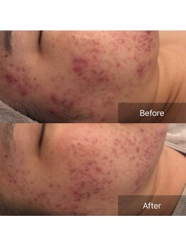 ラヴニール(L'avenir)/ニキビとはおさらば!