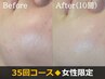 【顔脱毛×35回】一生モノの素肌投資。産毛・くすみ一掃。ノーファンデ肌へ
