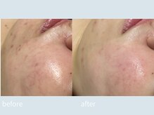 サロン ウル(salon Uru.)/ニキビができにくいお肌へ