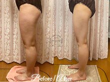 ラナンスパ(RANUN SPA)/外もも凸凹セルとハリ感も解消★