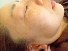 麻謝/Sou顔+ゼオライトマスク施術後