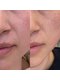 ラズリ(LazuLuLy)の写真/【30代・40代の大人女性に人気店】別人級★たるみ改善！年齢に伴う口元/まぶた/フェイスラインをリフトUP◎