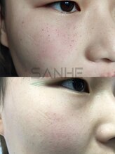 ソイ(soi)/光フェイシャル