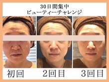 モルティープリマクラッセ 宇都宮東店(Molti Prima Classe)/たるみ/引き締め/小顔矯正/BTX