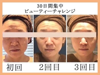 モルティー 宇都宮東店(Molti)/しわ/たるみ/引き締め/小顔矯正