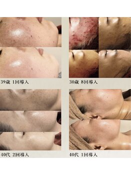 ミミルーチェ(mimiluce)/リアボーテハーブピーリング横浜