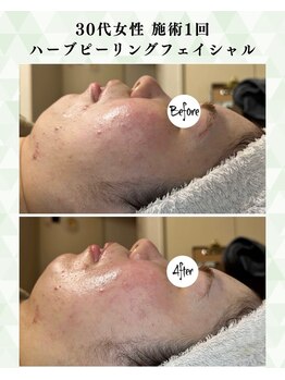 シーフェイス 横浜店(SEE FACE)/肌質改善ニキビハーブピーリング