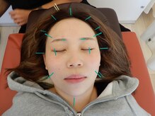 リ ムーヴ鍼灸整体院 大宮駅前院/美容鍼灸